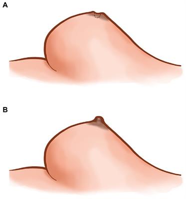 Corrective surgery for nipple depression in patients with plasmacytic mastitis – A single-center experience